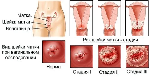 як лікувати рак матки