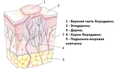 лікувати бородавку на пальці