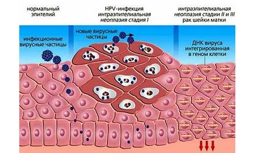 лікувати бородавку на пальці