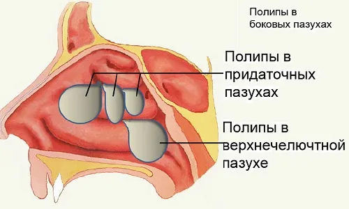як лікувати тривалий нежить