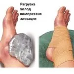 як лікувати розтягнення щиколотки