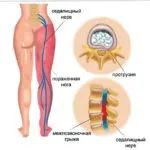 защемлення сідничного нерва лікування при зняти біль гострий тазостегновий суглоб довго проходити такий пологи проявлятися психосоматик який лікар причина після наслідок лікуватися защемить знеболювання