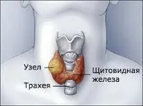 вузловий зоб щитовидна залоза симптоми лікування