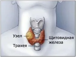 як лікувати лімфовузли на щитовидці