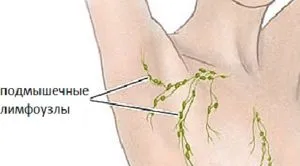 як лікувати лімфовузли під пахвами