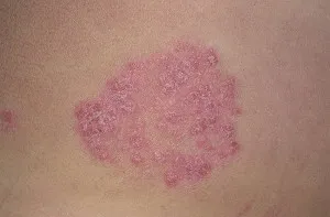Хронічний псоріаз: причини, форми, стадії, лікування та профілактика як лікувати хронічний псоріаз