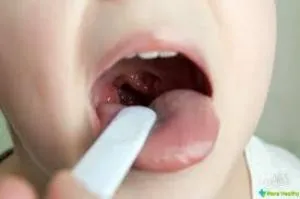 абсцес гланди