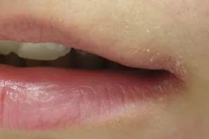Заїди на губах у дитини, причини причини появи в куточках губ у дитини