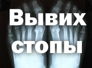 як лікувати вивих ноги