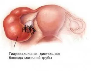 як лікувати трубне безпліддя
