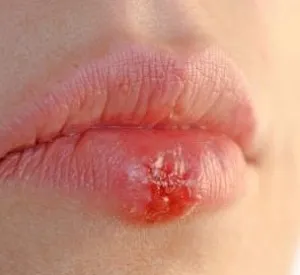 Сверблячка на губах: причини свербіж губи лікування причини