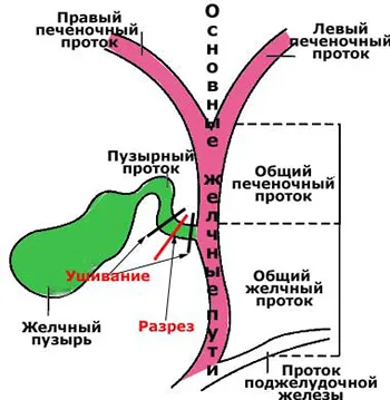 як лікувати печінку без жовчного міхура