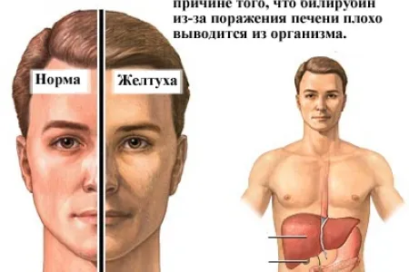 як лікувати гемолитическую жовтяницю