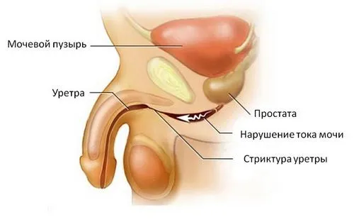 Уретрит: симптоми, причини, лікування як лікувати гонорейний уретрит