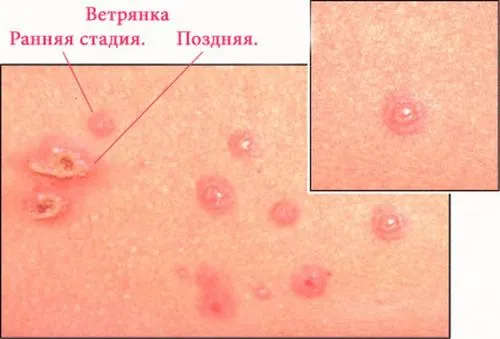 як лікувати вітрянку на губах