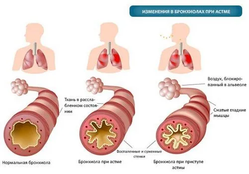 як лікувати алергічну астму