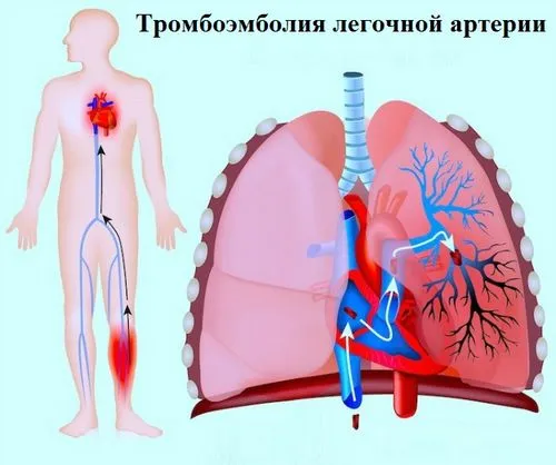як лікувати тромбоемболії легенів