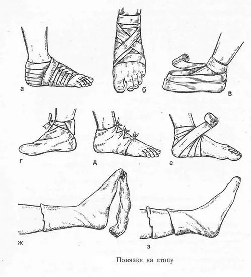 як лікувати вивих ноги