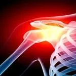 як лікувати деформуючий артроз плечового суглоба