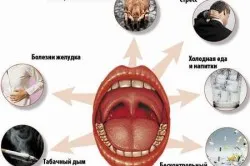 лікувати фарингіт антибіотиками