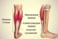 як лікувати розтягнення ахіллового сухожилля