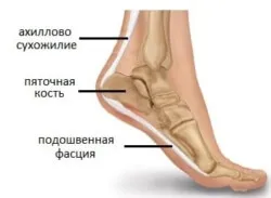 як лікувати розтягнення ахіллового сухожилля