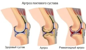 як лікувати ліктьовий артроз