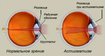 як лікувати астигматизм у дорослих