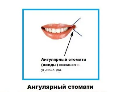 як лікувати кандидозні заїди