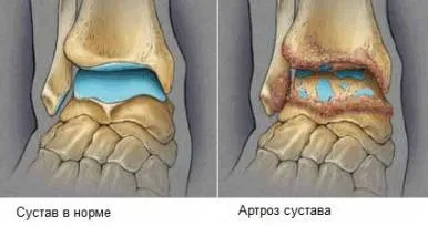 чи можна лікувати деформуючий артроз