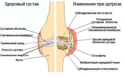 як лікувати артроз хребта