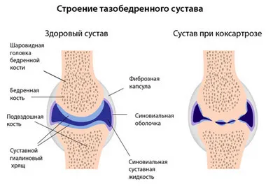 артроз тазостегнового суглоба 1 ступеня