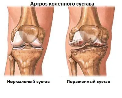 артроз види лікування стопи операція лікування