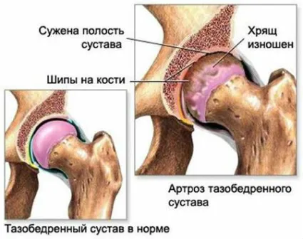 як лікувати артроз 2 ступеня