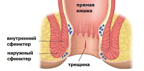 як вилікувати геморой і тріщини