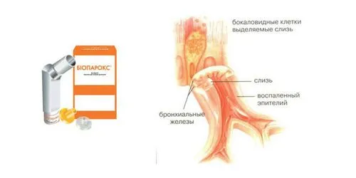 як лікувати бактеріальний фарингіт