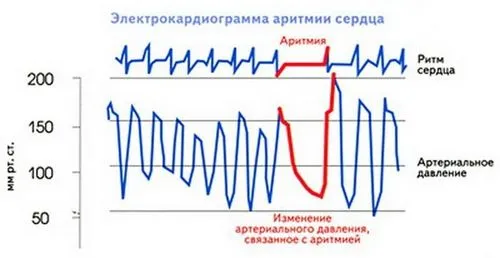 як лікувати аритмію при вагітності