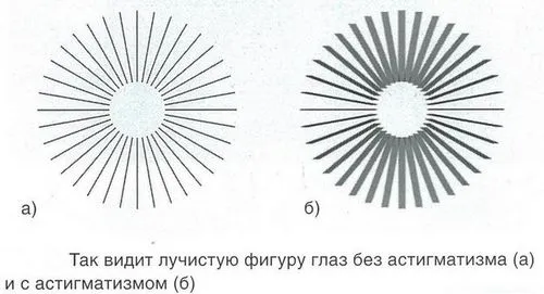 як лікувати дитячий астигматизм