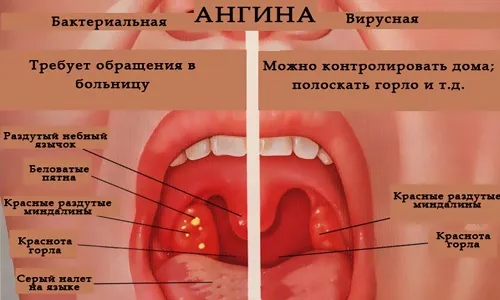 лікувати ангіну дитині 4 роки