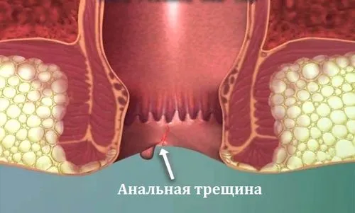 як вилікувати геморой і тріщини