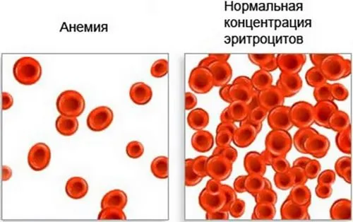 анемія у людей похилого віку