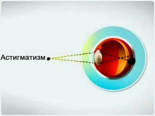 астигматизм дитина лікується чи ні змішаний гіперметропіческій гімнастика далекозоре лікування