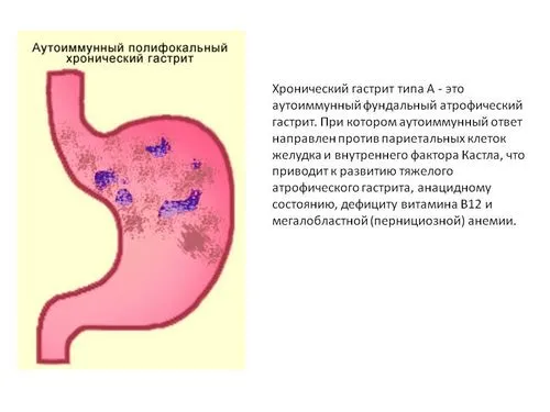 Аутоімунний гастрит: лікування, симптоми, діагностика як лікувати лімфоцитарний гастрит