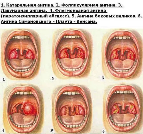 ніж лікувати дитині ангіну