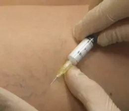 vene varicoase în tratamentul femeilor și prevenirea