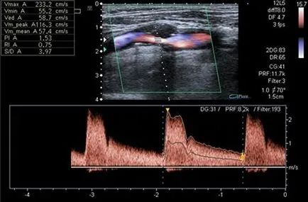 Ecografie Doppler a vaselor de cap și gât, ceea ce arată că este, prețul (a) Ecografie Doppler a vaselor de cap și gât, indicând faptul că acesta este prețul