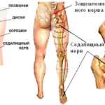 болить сідничний нерв робити причина чого симптом застудити коли довго розтягнення лікування захворювання лікувати защемлення хребет прояв запалення воспальний запалитися як біль від затиснути що знеболити пошкодження ніж забій бджіл
