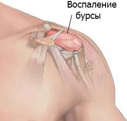 як лікувати бурсит плеча в домашніх умовах