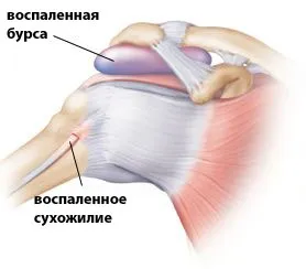як лікувати вапняний бурсит