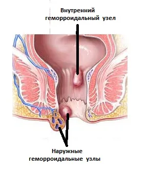 ніж лікувати геморой у жінок